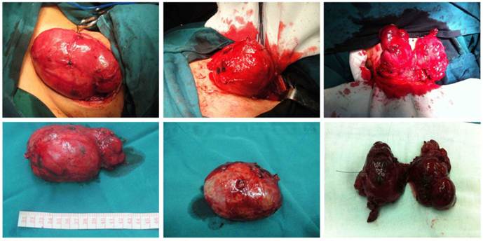 The picture shows the patient has undergone a goiter surgery. The doctor has taken out a giant nodular goiter from the patient’s neck.